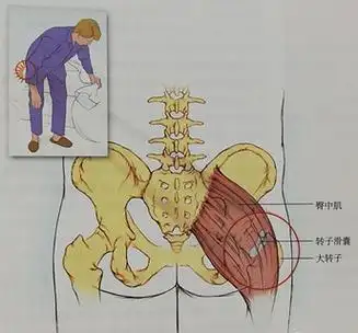 大转子上方疼痛,不能于患侧卧位,走路略呈跛行.
