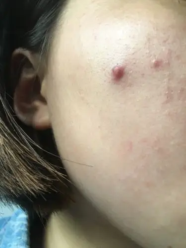 长了一个大痘痘,应该怎么消除啊,有点疼,好几天了一直没有冒白头