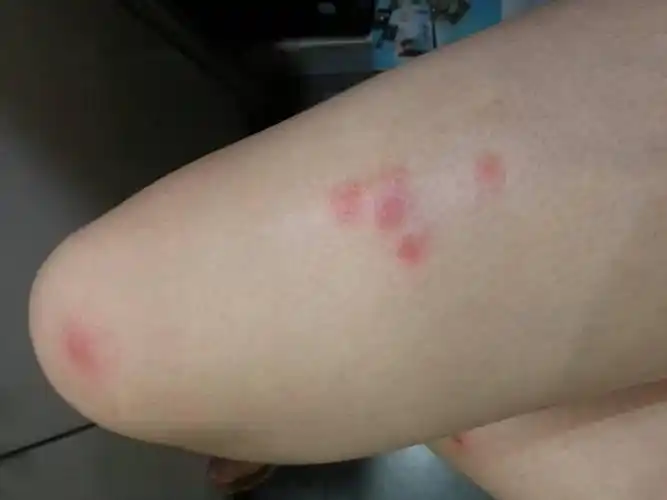 身上起红疙瘩很痒图