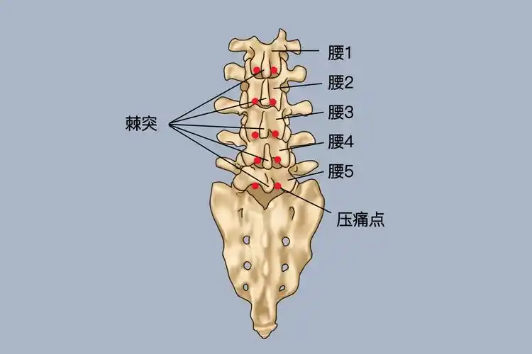 腰突即腰椎间盘突出症,痛点的位置在病变间隙的棘突间,查体时可有压痛