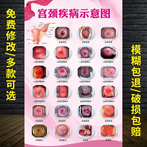 宫颈疾病示意图 女性生殖器系统解剖图女性子宫图片妇科海报挂图