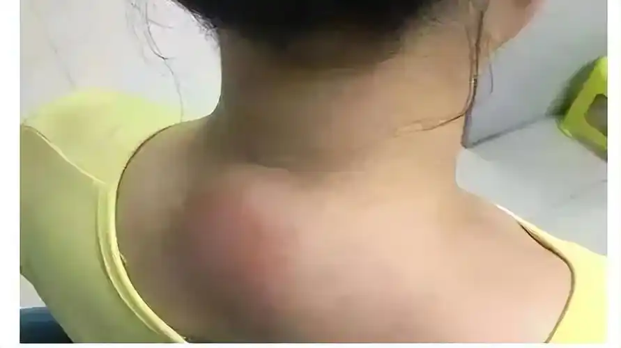 富贵包实质上是由于人们胸椎和上颈段灵活性不足,下颈段过多地代偿