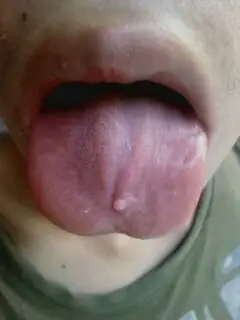 这个是口腔溃疡吗,,,舌头有个小泡,没有其他不适.