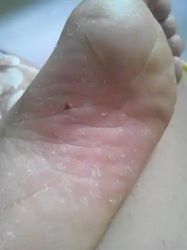 脚脱皮.脱的特严重,咋治啊.