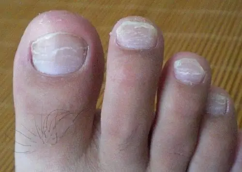 儿子不到3岁脚趾甲有横纹是怎么回事?图片上的情况跟我儿子的差不多?