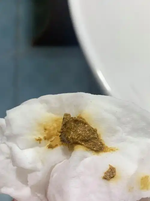 讨论/科普|【讨论】大便里的白色点点 有图慎入 已善用搜索