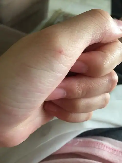 被没打疫苗的猫抓破皮了 第二天就这样了 请问会有事吗?