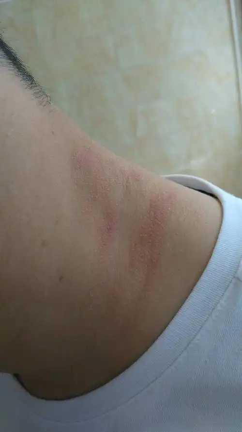 脖子上嗮了太阳就出现些向痱子一样的东西,手摸了就变成这样了遇热会