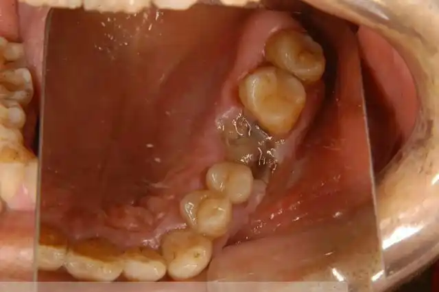 牙龈癌早期症状图片(2)