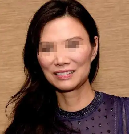 颧骨变窄也能抗衰专家说面部抗衰不要忽视颧骨