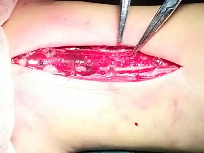 庆阳市中医医院骨二科首例外踝骨折可吸收钢板内固定术