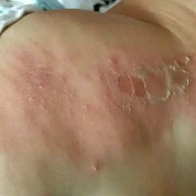 我家宝宝好可怜,屁股莫名其妙就烂了帮我看看怎么回事,急