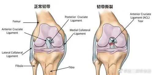 人老腿先衰如果你的膝盖咔嚓作响或松动有可能是这种情况