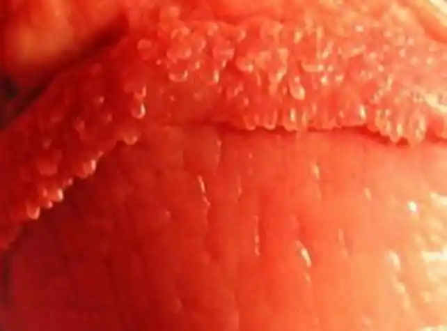 假尖锐湿疣白醋测试图片_有来医生