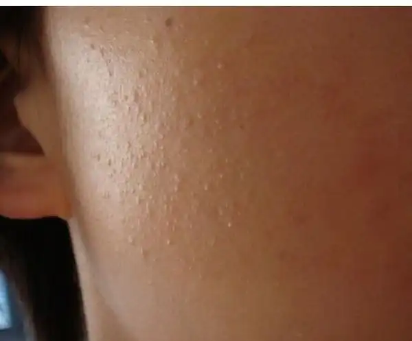 粉刺是什么可以吃么