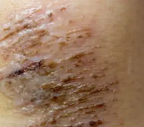 真皮层伤到什么程度留疤1