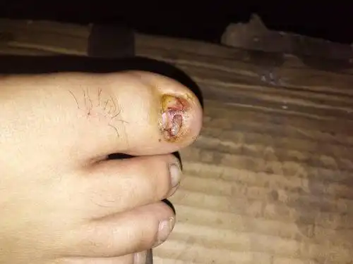 脚趾甲被砸伤后化脓,然后去医院拔了才一天又长出白色的是指甲还是化