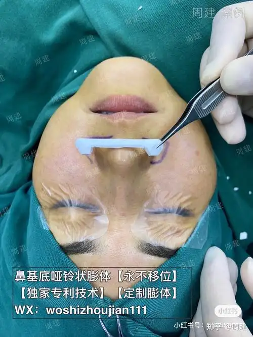 鼻基底假体怎么做才能不移位 - 知乎