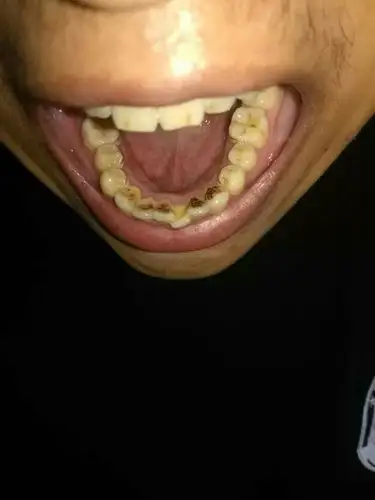 牙齿发黑怎么办 求医生 帮忙