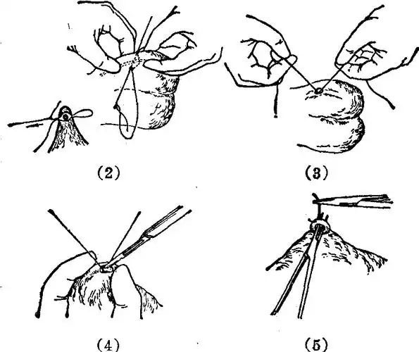 穿针引线法输精管结扎术-医学百科全书-计划生育-医学
