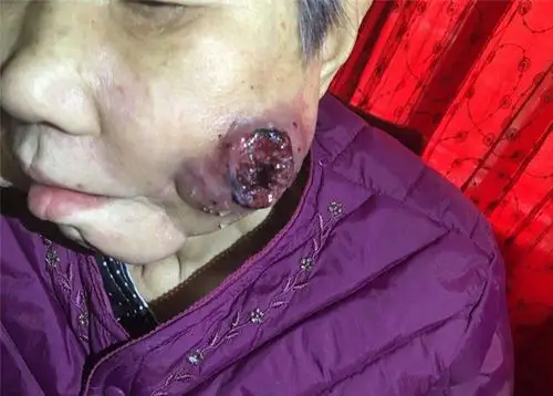 口腔癌的晚期的症状图片