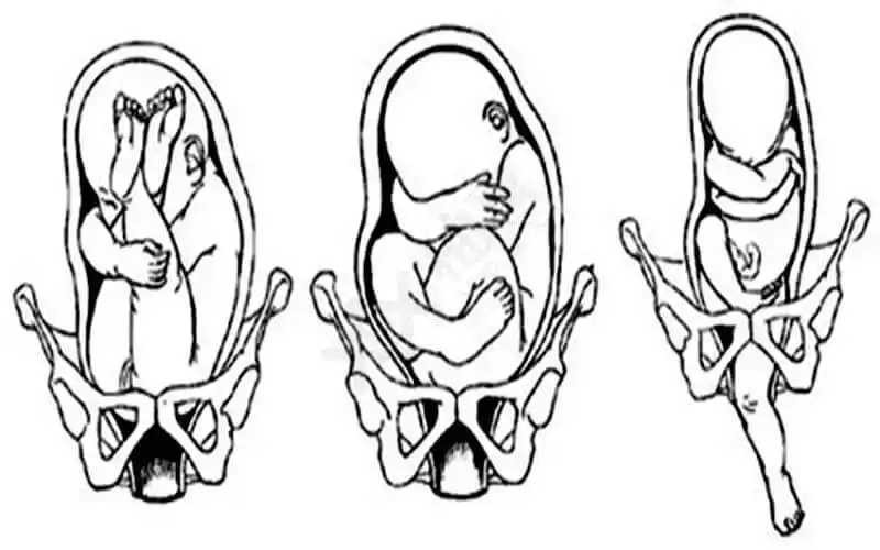 揭秘枕后位孕妇能否顺产,背后的风险不得不了解