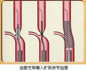 我院成功完成一例重度复杂冠状动脉支架植入术