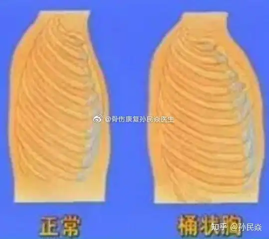 孙民焱 的想法: 桶状胸 年青阶段较容易误认为是强壮感 - 知乎