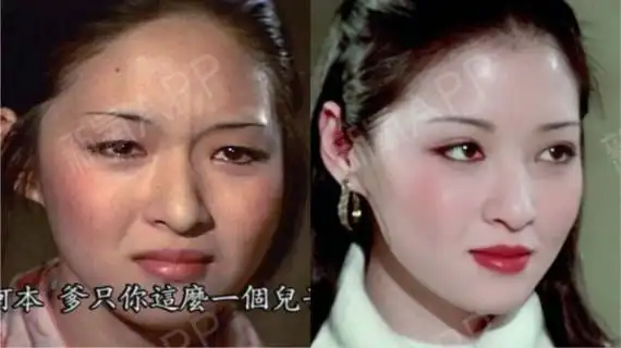 胡因梦单眼皮和双眼皮对比做了上眼皮去脂和双眼皮手术的胡因梦,美貌