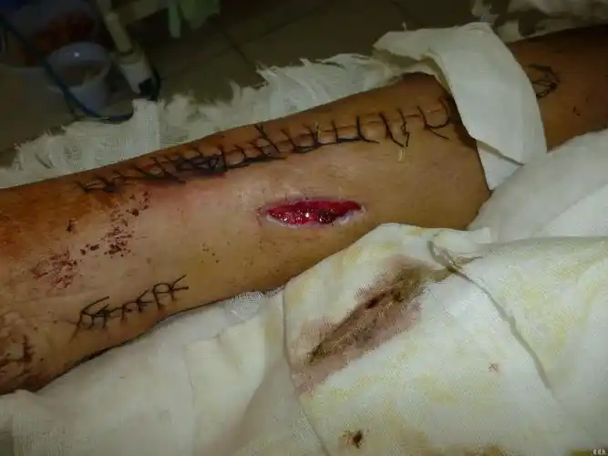 胫腓骨骨折内固定