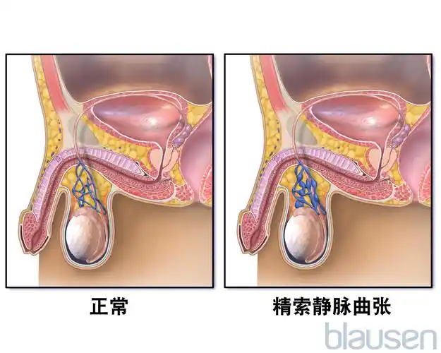 精索静脉曲张