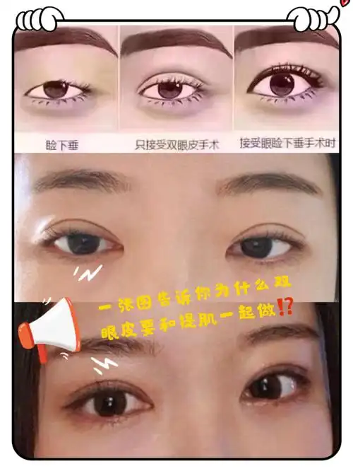 一张图告诉你为什么双眼皮要和提肌一起做63