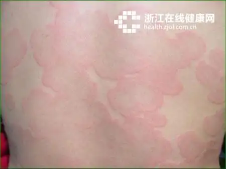 4年了,男孩背上黑斑总算找到了病因 竟是因为感冒药