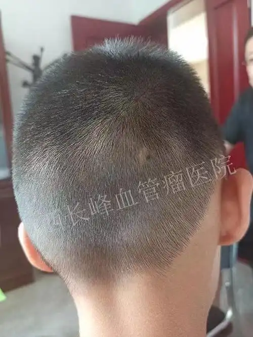 这个患儿是一个头部的血管瘤,治疗了一个疗程,肿块明显缩小,还在慢慢