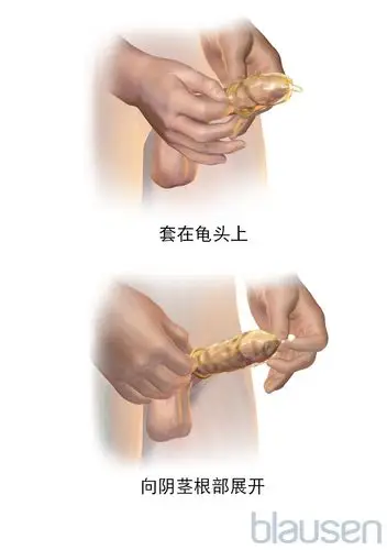 如何戴避孕套