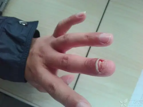 指甲畸形～～～请大神赐教!如何处理比较好～～ [病例帖]