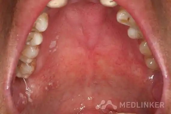 hiv感染相关的口腔念珠菌病2例