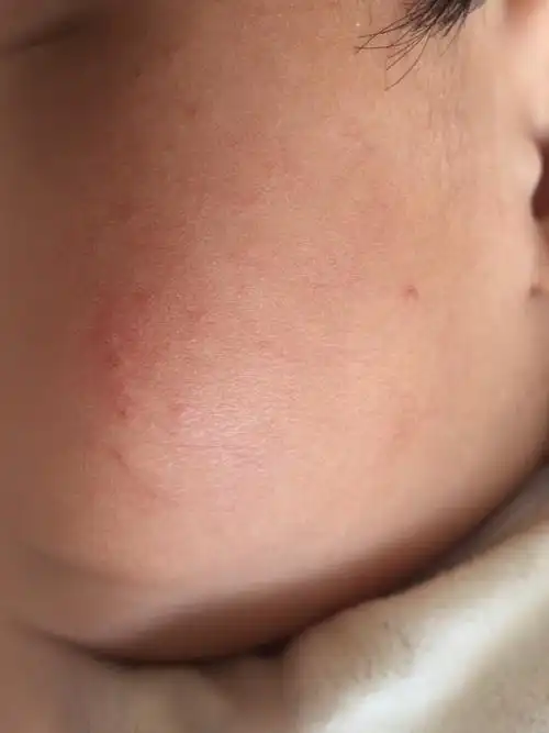 宝宝流口水脸上有红点怎么办