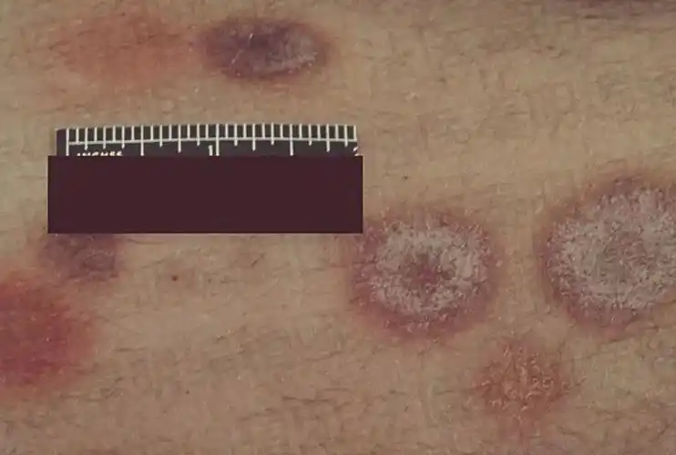 的颜色则主要和霉菌的种类有关(比如后文案例中提到的一例毛霉菌感染)