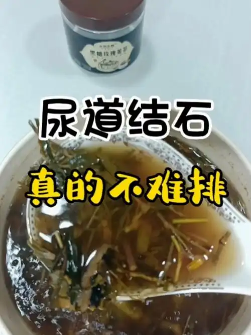 帮助结石快速排出体外#泌尿系结石  #尿道结石 #肾结石尿结石排石