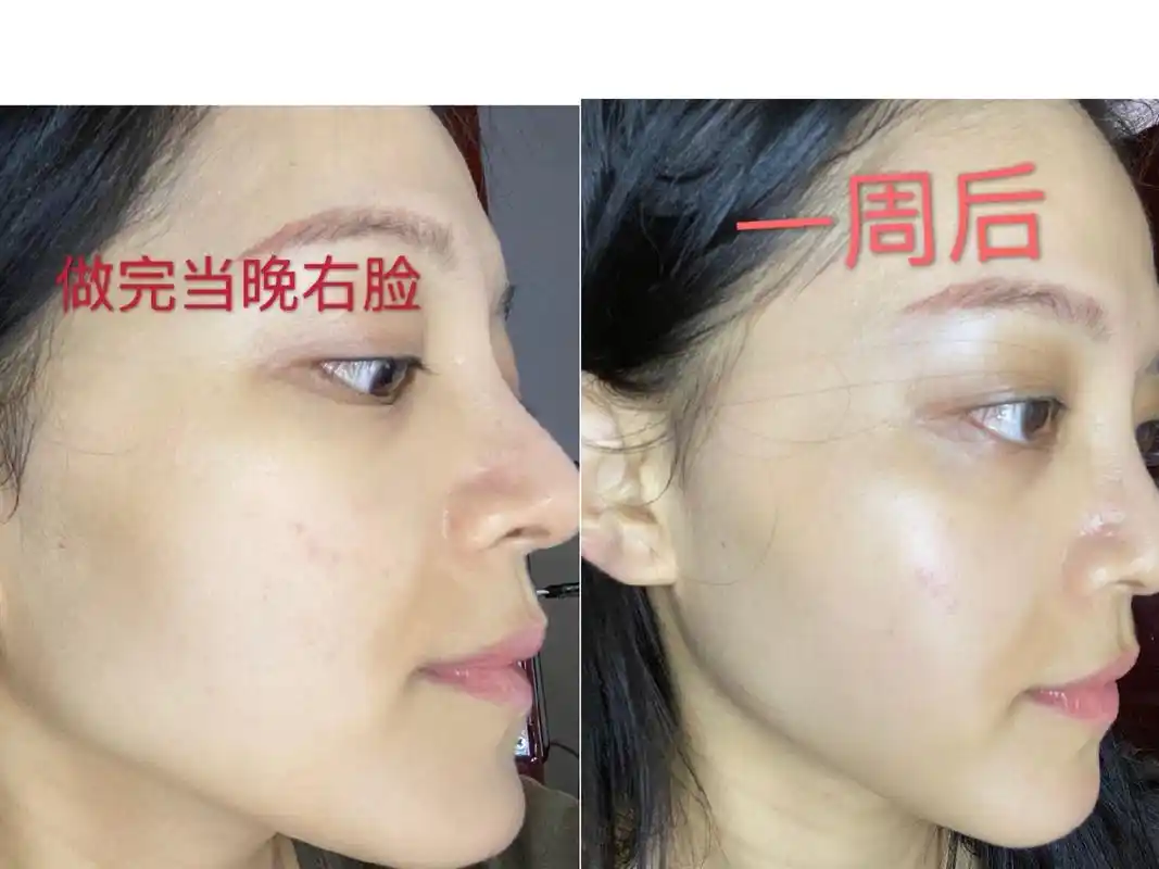 我来啦~这是做完m22光子嫩肤一周后的效果反馈