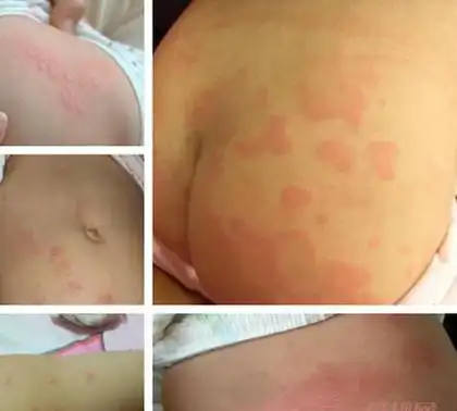 用手摸会发现有发硬的感觉,瘙痒剧烈儿童荨麻疹的特点是过敏反应所