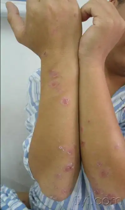 梅毒病例讨论四肢红斑鳞屑4月余阴囊肿胀疼痛10余天