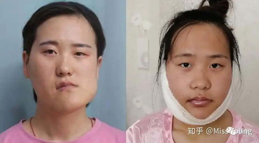 由于小秋的偏颌严重,医生进行了一系列的手术,才得到右图的正常颌面.
