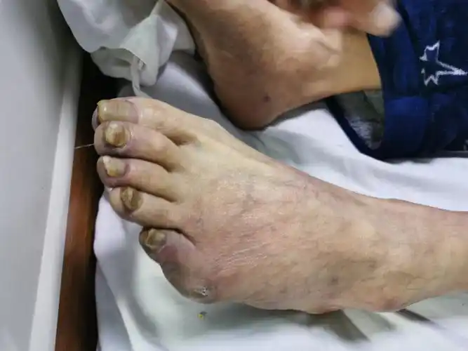 双下肢动脉硬化闭塞