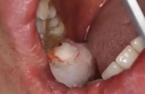 张东星老师病例分享6下颌智齿冠周炎继发皮下脓肿科贸嘉友收录