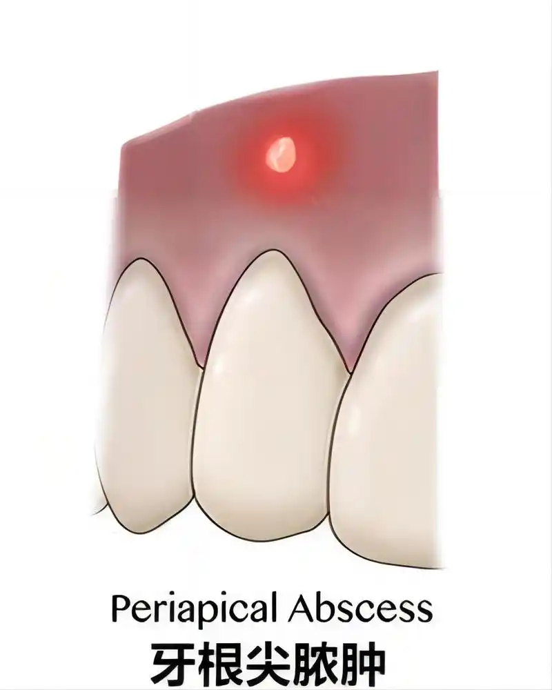 「牙龈鼓脓包」牙根脓包自己戳破?壮士快住手!