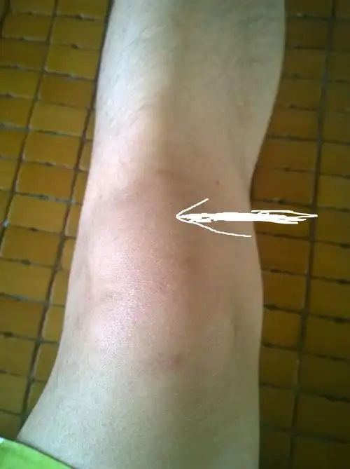 膝盖肿胀痛,膝盖后面好像是筋也肿胀.