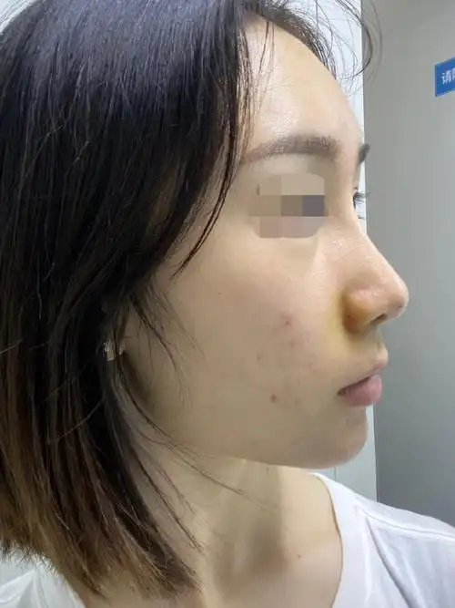 外切鼻翼一周拆线即刻