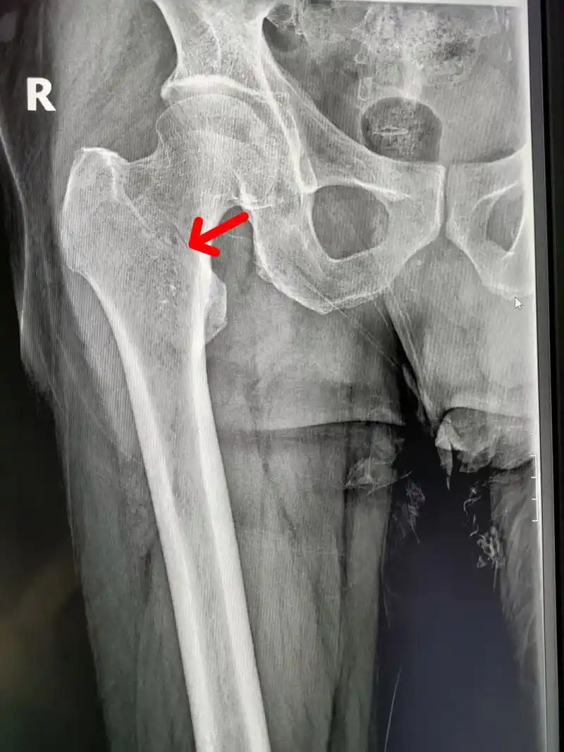 男,67岁,因滑倒就诊,右股骨粗隆间骨折,就是我们老百姓说的大腿根的